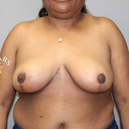 Breast Reduction before and after - after