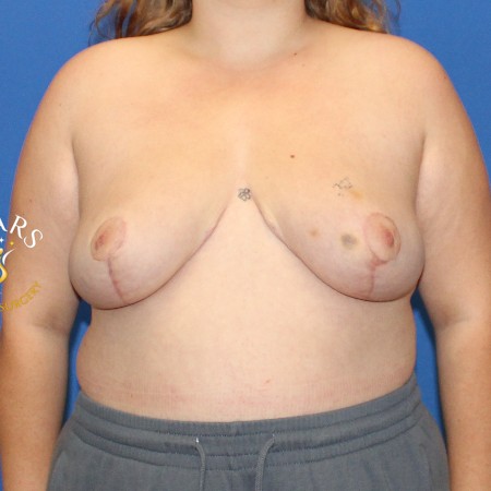 Breast Reduction before and after - after