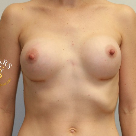 Breast Lift before and after - after