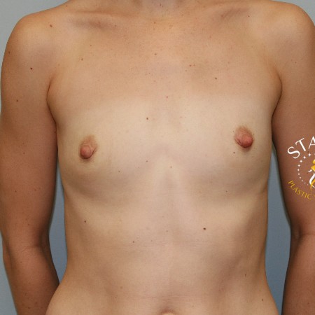 Breast Lift before and after - before