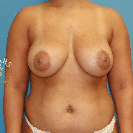 Breast Reduction before and after - after