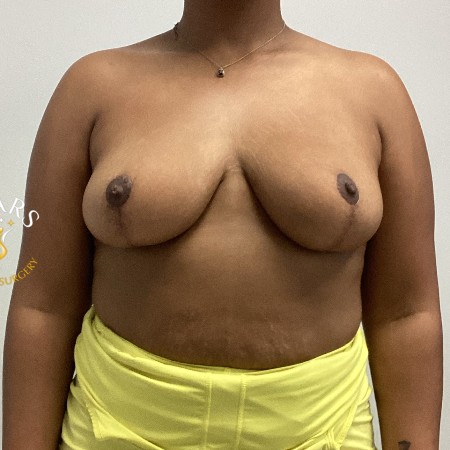 Breast Reduction before and after - after