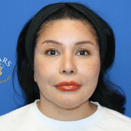 Facelift before and after - after