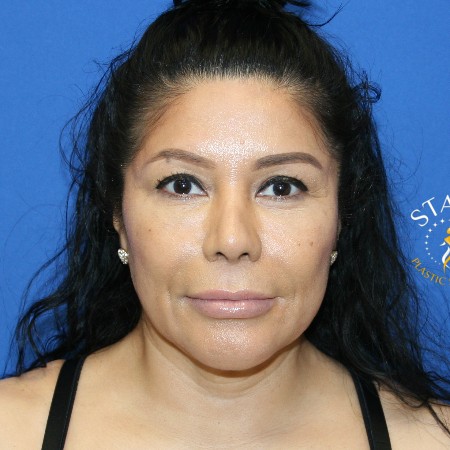 Facelift before and after - before