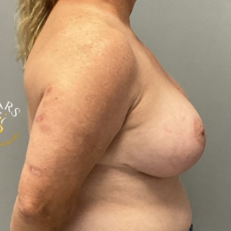 Breast Augmentation with Lift before and after - after