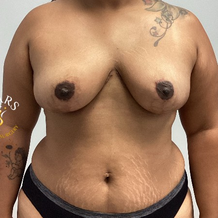 Breast Augmentation with Lift before and after - after