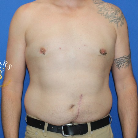 Gynecomastia before and after - after