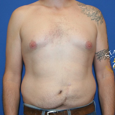 Gynecomastia before and after - before