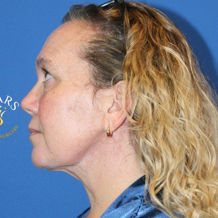 Neck Lift before and after - after