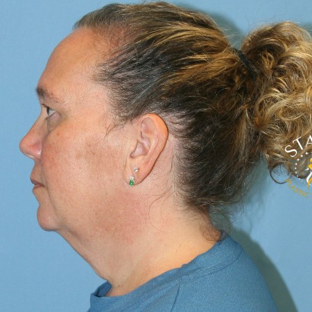 Neck Lift before and after - before