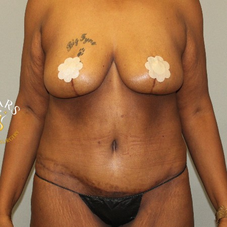 Tummy Tuck before and after - after