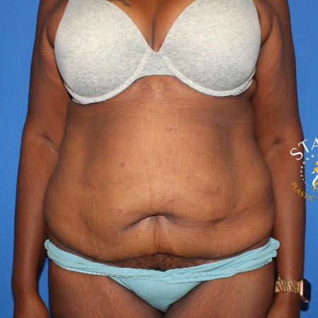 Tummy Tuck before and after - before