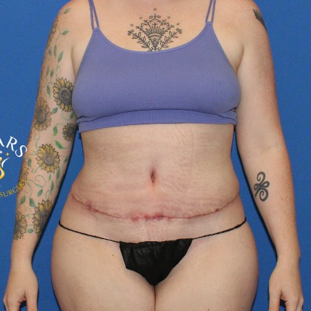 Tummy Tuck before and after - after