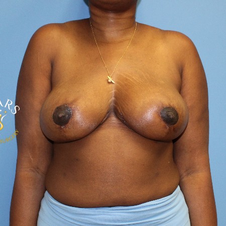 Breast Lift before and after - after
