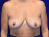 Breast Augmentation with Lift before and after - before
