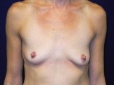 Breast Augmentation with Lift After Pregnancy before and after - before