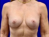 Breast Augmentation with Lift before and after - after