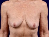 Breast Augmentation with Lift before and after - before