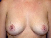 Breast Augmentation with Periareolar Mastopexy before and after - after
