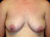 Breast Augmentation with Periareolar Mastopexy before and after - before