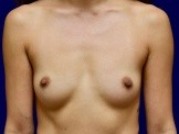 Breast Augmentation before and after - before