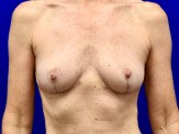 Breast Implant Removal & Breast Lift before and after - after