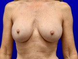 Breast Implant Removal & Breast Lift before and after - before