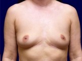 Breast Implant Removal with Partial Breast Lift before and after - after