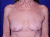 Breast Implant Removal after — Dr. Paul Pin