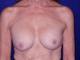 Breast Implant Removal before — Dr. Paul Pin