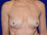 Breast Implant Removal after — Dr. Paul Pin