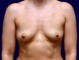 Breast Augmentation before and after - before