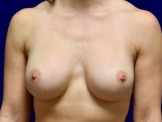 Breast Implant Revision before and after - before