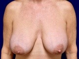 Breast Augmentation Revision with Galaflex & Breast Lift before and after - before
