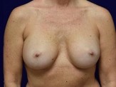 Breast Implant Revision with Galaflex before and after - after