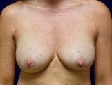 Breast Implant Revision with Silicone Implants & Galaflex before and after - before