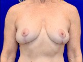 Breast Lift before and after - after
