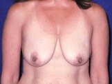 Breast Lift before and after - before