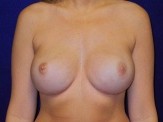Nipple Sparing Mastectomy before and after - after