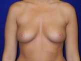 Nipple Sparing Mastectomy before and after - before
