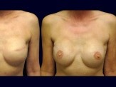 Breast Reconstruction before and after - after
