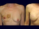 Breast Reconstruction before and after - before