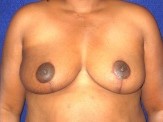 Partial Mastectomy with Oncoplastic Breast Reconstruction before and after - after