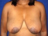Partial Mastectomy with Oncoplastic Breast Reconstruction before and after - before