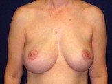 Breast Reconstruction before and after - after