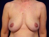 Breast Reconstruction before and after - before