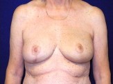 Breast Reconstruction before and after - after