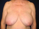 Breast Reconstruction before and after - before