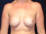 Breast Reconstruction before and after - after