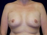 Breast Reconstruction before and after - after
